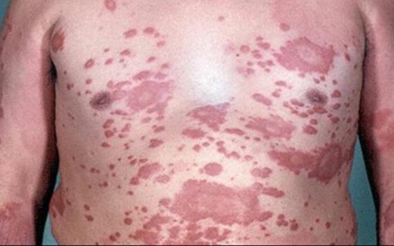 Detectan caso de lepra en Tabasco