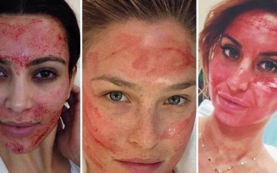 Se contagian de VIH clientes de un spa por Facial de vampiro