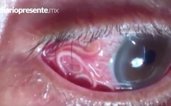 VIDEO: Retiran gusano del ojo de un hombre