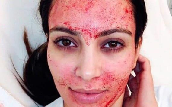 Spa hace famoso facial vampiro y contagia a clientas de VIH