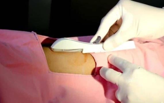 Mujer decide colocarse implante anticonceptivo y se le va al pulmón