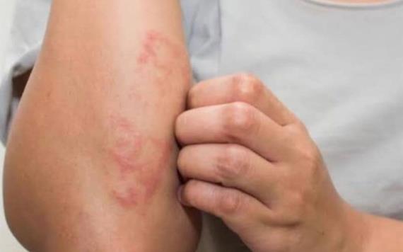 Detectan lepra en Quintana Roo, 10 pacientes en tratamiento