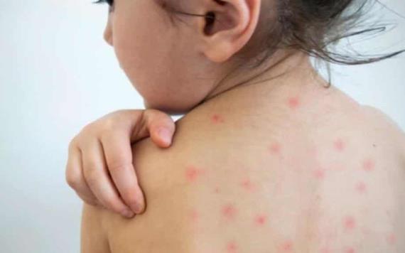 Suman 150 casos de sarampión en México