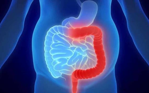 ¿Sufres colitis? así puedes reducir molestias y evitar que empeore