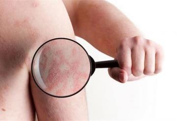 Psoriasis ¿Qué es y cuáles son sus síntomas?