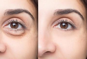 Te decimos cómo eliminar ojeras y bolsas de ojos