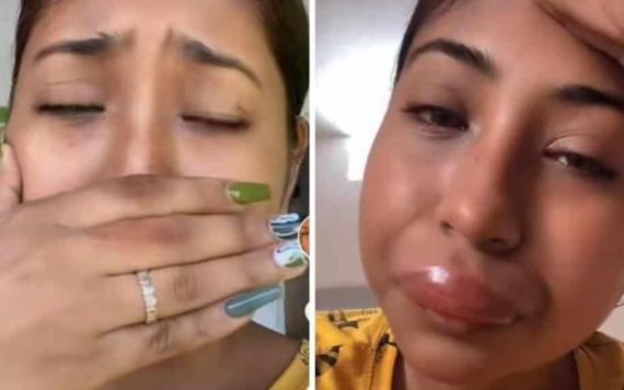 Joven compartió cómo su rostro se deformó luego de ser picado por una abeja