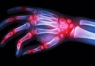 Pacientes jóvenes con artritis reumatoide tienen más riesgo de fracturas antes de los 50 años