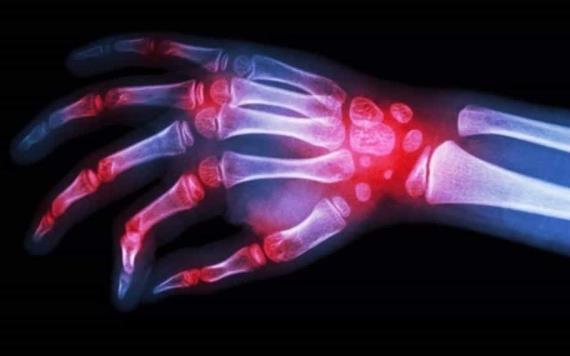 Pacientes jóvenes con artritis reumatoide tienen más riesgo de fracturas antes de los 50 años