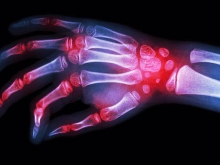 Pacientes jóvenes con artritis reumatoide tienen más riesgo de fracturas antes de los 50 años Pacientes jóvenes con artritis reumatoide tienen más riesgo de fracturas antes de los 50 años