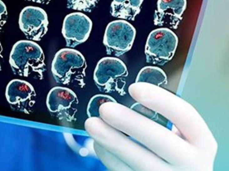 Covid podría reducir ligeramente el cerebro y provocar menos materia gris en las regiones del olfato y la memoria Covid podría reducir ligeramente el cerebro y provocar menos materia gris en las regiones del olfato y la memoria