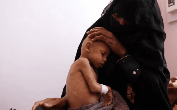 En Yemen, millones de niños en riesgo de morir por desnutrición aguda