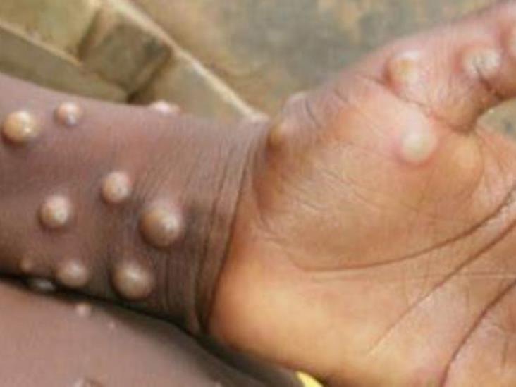 ¿La viruela del Mono es contagiosa? Cómo se propaga la enfermedad ¿La viruela del Mono es contagiosa? Cómo se propaga la enfermedad