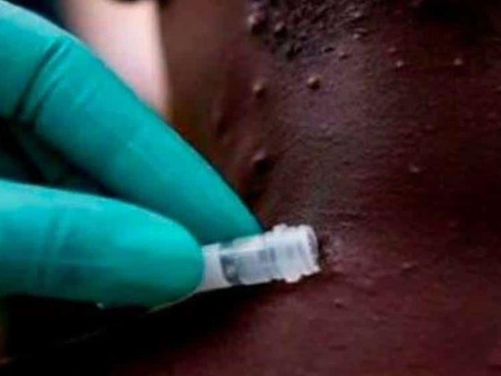 ¿Qué población tiene mayor riesgo de contagio del virus del mono? ¿Qué población tiene mayor riesgo de contagio del virus del mono?
