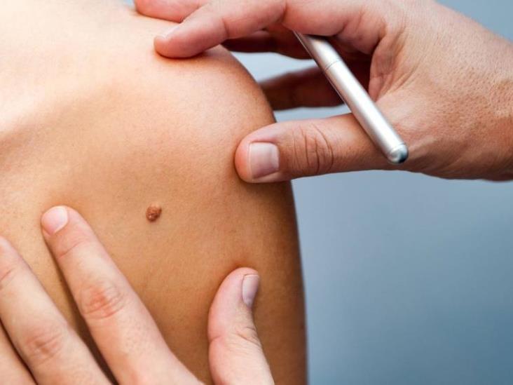 Día Mundial del Melanoma: por qué es importante checar los lunares Día Mundial del Melanoma: por qué es importante checar los lunares