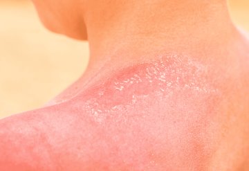 Alertan sobre aumento de cáncer de piel en personas menores de 65 años