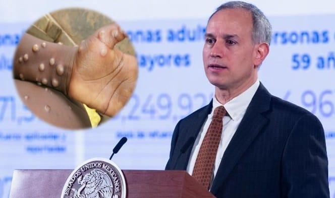 Confirma Hugo López-Gatell primer caso importado de viruela del mono en México Confirma Hugo López-Gatell primer caso importado de viruela del mono en México