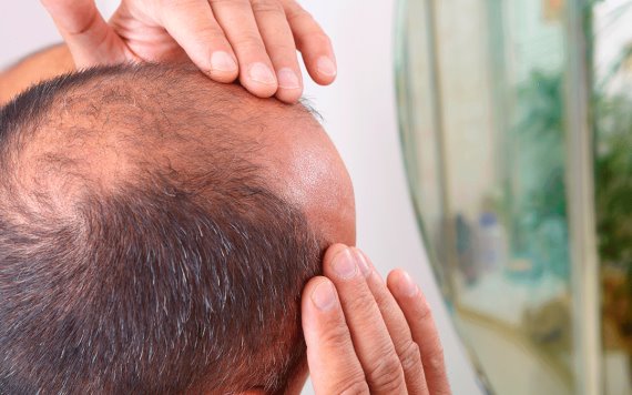 FDA aprueba primer tratamiento contra alopecia
