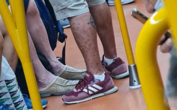 Hombre viaja en el Metro lleno de lesiones de la cabeza hasta los pies de viruela del mono