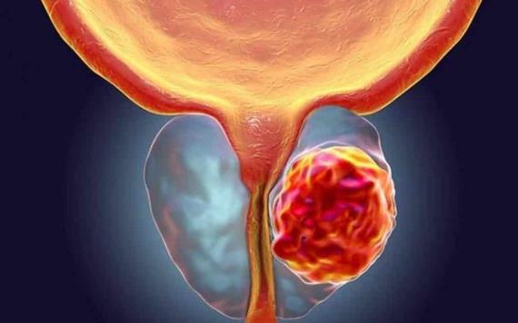 Bayer presenta nueva terapia contra cáncer de próstata que reduce mortalidad