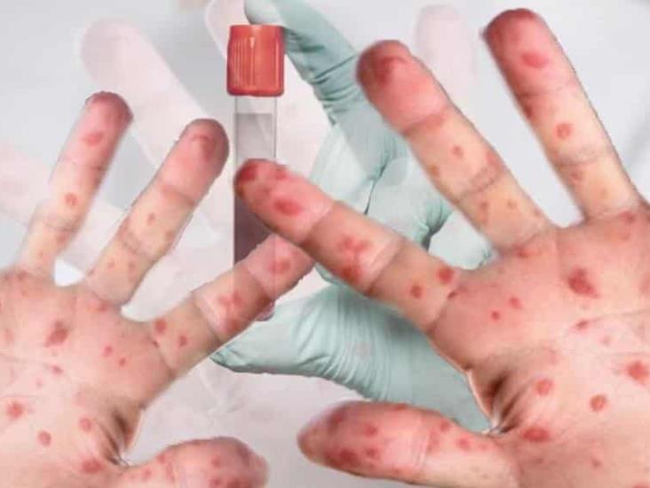 Casos de viruela del mono aumentan a más de mil en México Casos de viruela del mono aumentan a más de mil en México