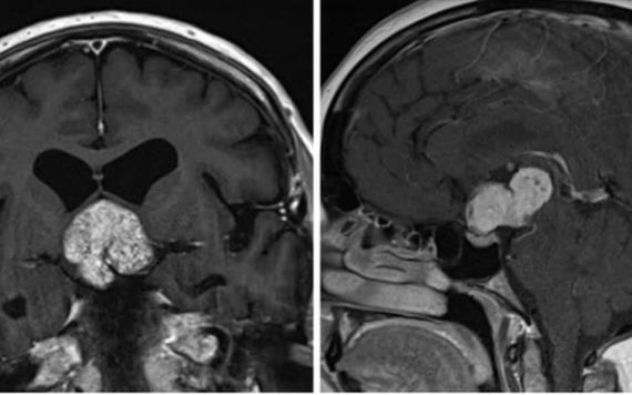 En casos raros, la viruela del simio puede provocar una peligrosa inflamación en el cerebro