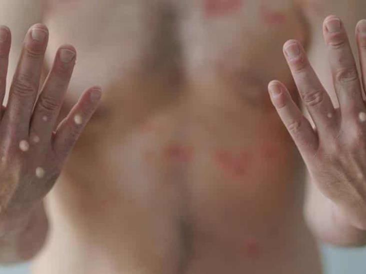 Reportan mil 968 casos de virus del mono en México Reportan mil 968 casos de virus del mono en México