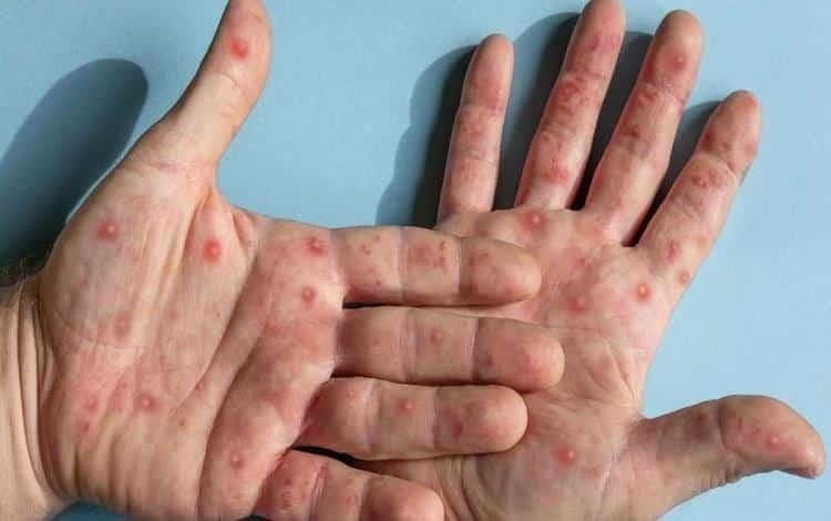 Viruela del mono continúa en nivel de alerta máxima: OMS Viruela del mono continúa en nivel de alerta máxima: OMS