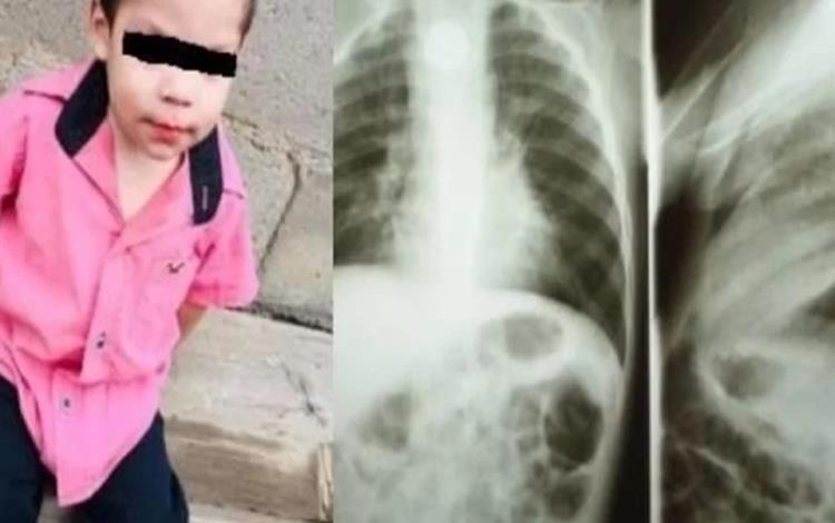 Niño de dos años se traga pila y le explota en el esófago; permanece grave en hospital de Sonora Niño de dos años se traga pila y le explota en el esófago; permanece grave en hospital de Sonora