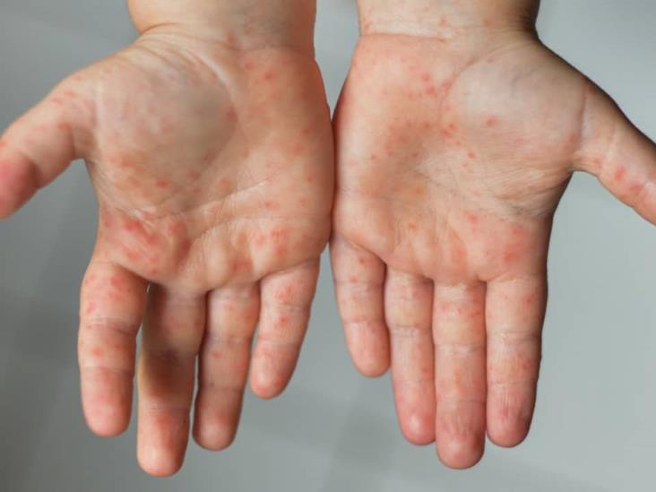 Tras aumento de contagio del virus Coxsackie, primarias en Veracruz suspenden clases Tras aumento de contagio del virus Coxsackie, primarias en Veracruz suspenden clases