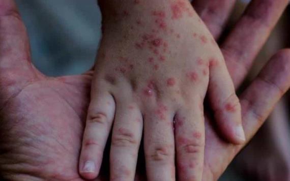 Paraguay confirmó su primer caso de sarampión en 25 años