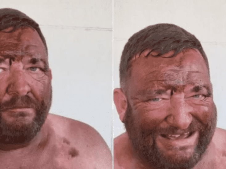 Hombre se quiso broncear para una cita, pero se quedó dormido y tuvo que ir con la piel color ´naranja´ Hombre se quiso broncear para una cita, pero se quedó dormido y tuvo que ir con la piel color ´naranja´