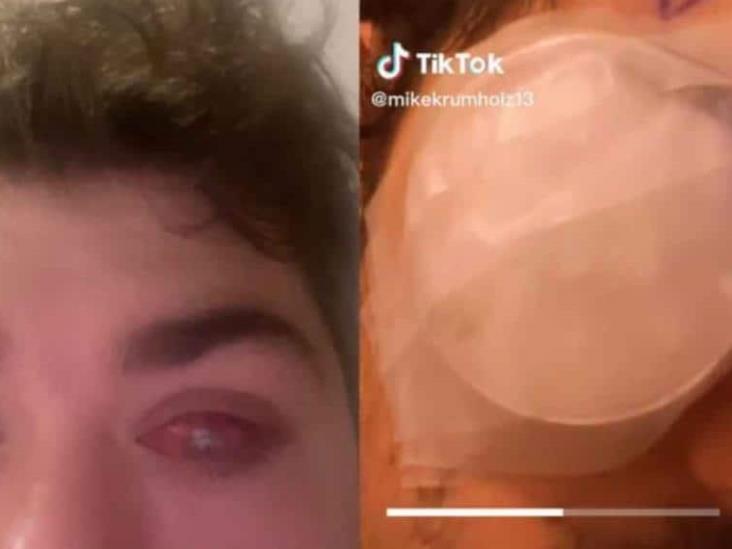 Joven toma una siesta con sus lentes de contacto y queda ciego de un ojo Joven toma una siesta con sus lentes de contacto y queda ciego de un ojo