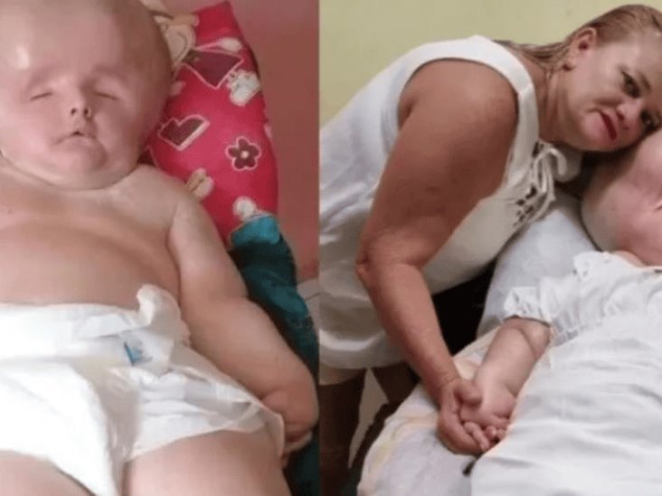 Madre responde a quienes se burlan de su bebé con hidrocefalia Madre responde a quienes se burlan de su bebé con hidrocefalia