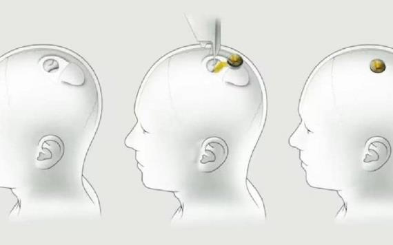 Implante cerebral, primer ensayo en humanos