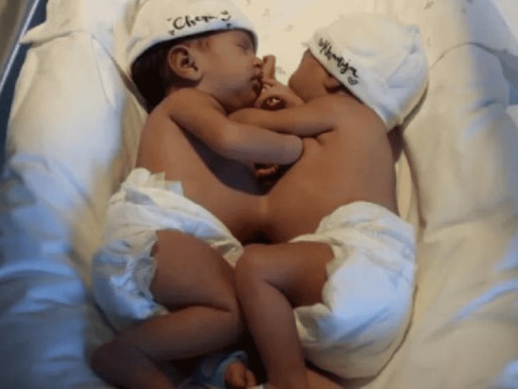 Separan con éxito a gemelas siamesas; lo califican como un milagro médico Separan con éxito a gemelas siamesas; lo califican como un milagro médico