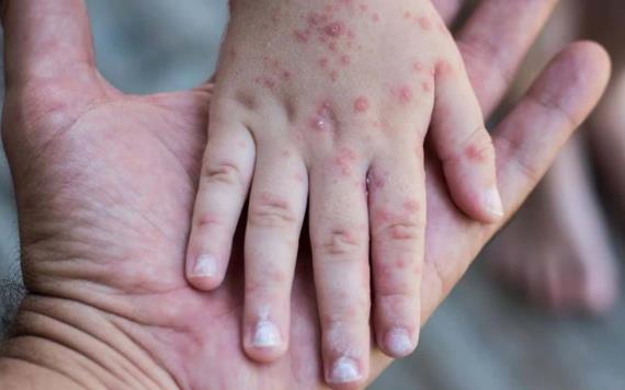Alerta OMS por aumento de muertes por sarampión tras descenso en vacunación