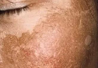 Evite cáncer de piel por exposición excesiva a rayos ultravioleta: IMSS Tabasco