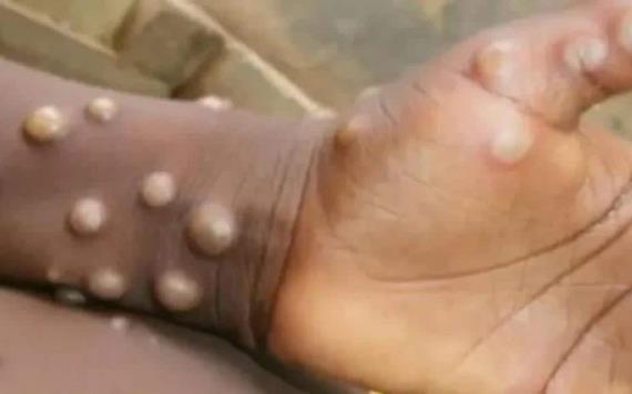 Viruela del mono: Morelos ha registrado 2 casos de mpox en lo que va del año; piden mantener medidas preventivas